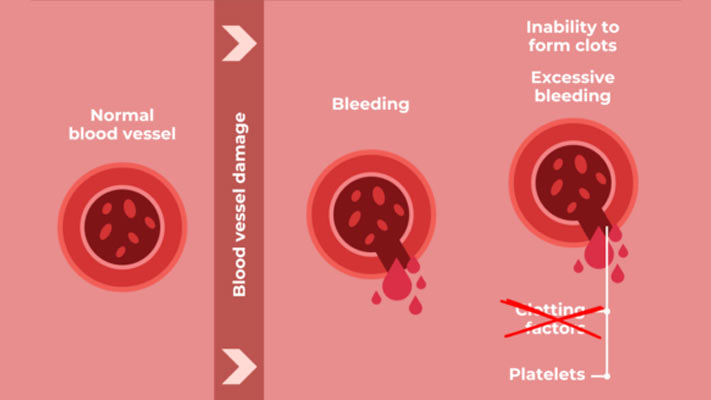 deficiency-of-factors